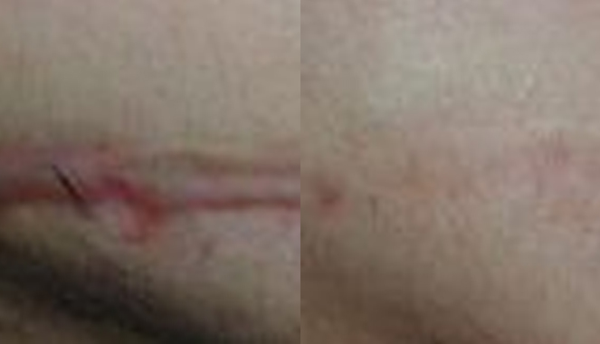 Scar Removal Archives