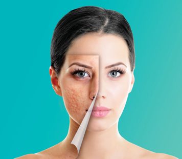 Acne & Acne Scar Treatment Toronto