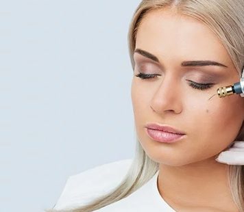 birthmark removal Toronto