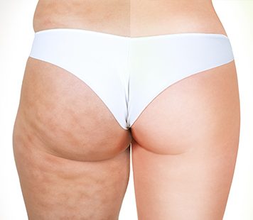 cellfina - Fairview laser clinic