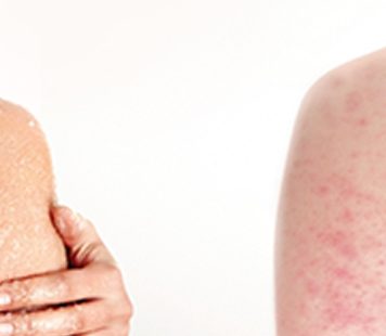 keratosis in Toronto