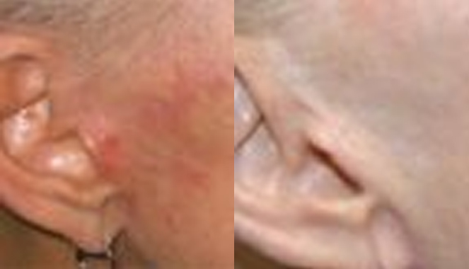 Scar Removal Archives