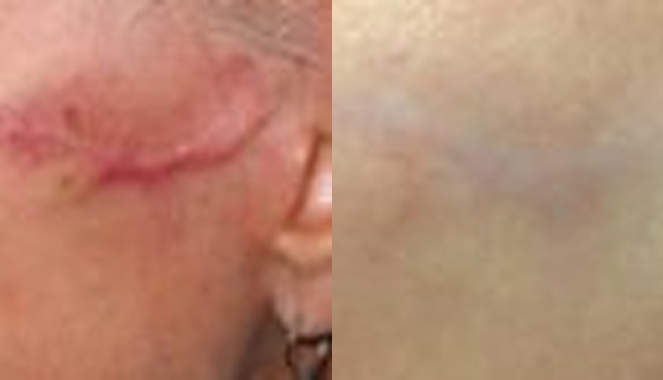 Scar Removal Archives