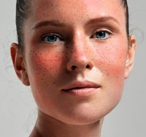 laser treatment for Rosacea in toronto